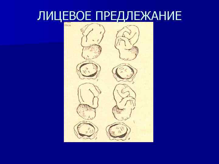 ЛИЦЕВОЕ ПРЕДЛЕЖАНИЕ 