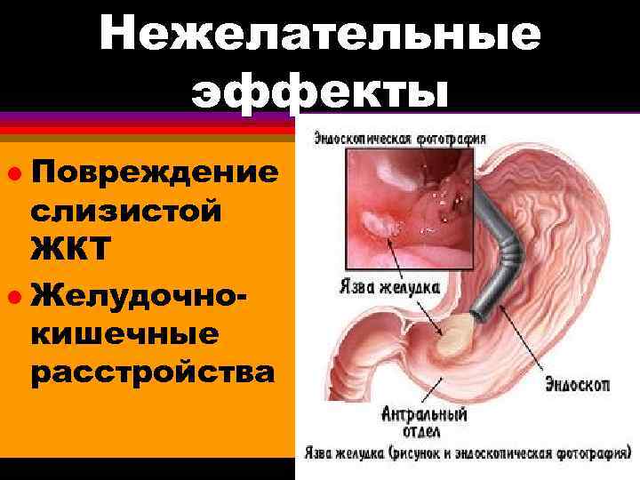 Нежелательные эффекты Повреждение слизистой ЖКТ l Желудочнокишечные расстройства l 