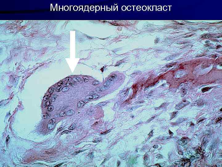 Многоядерный остеокласт 