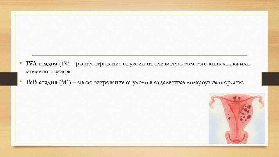  • IVA стадия (Т 4) – распространение опухоли на слизистую толстого кишечника или
