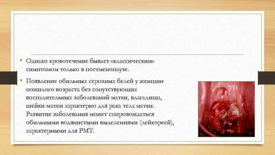  • Однако кровотечение бывает «классическим» симптомом только в постменопаузе. • Появление обильных серозных