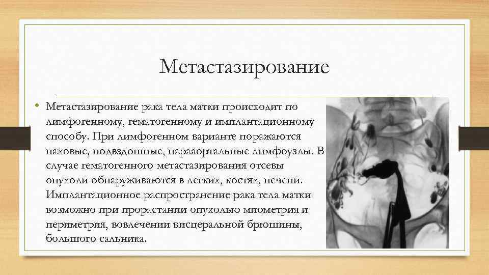 Метастазирование • Метастазирование рака тела матки происходит по лимфогенному, гематогенному и имплантационному способу. При