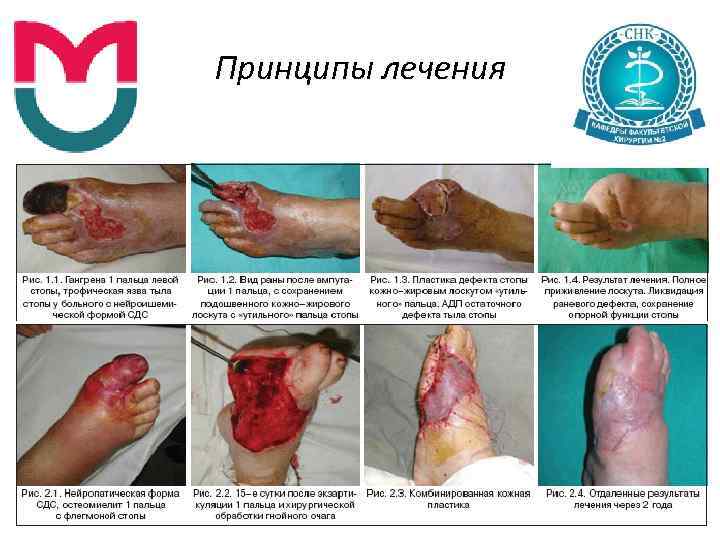 Принципы лечения 