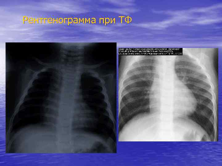 Рентгенограмма при ТФ 