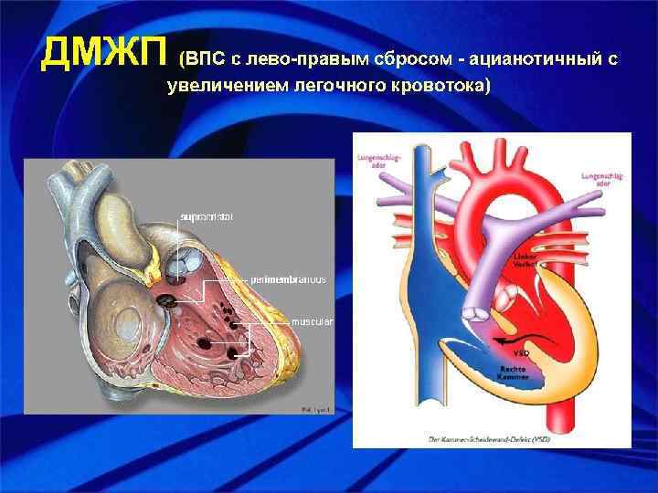 Врожденный порок митрального клапана