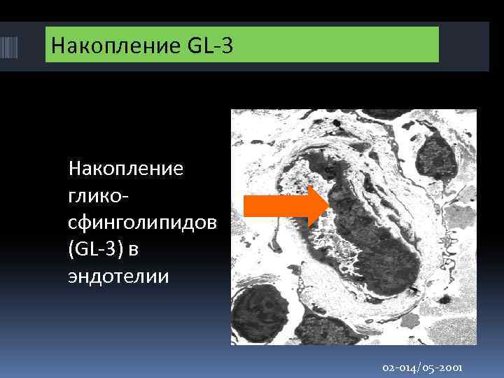 Накопление GL-3 Накопление гликосфинголипидов (GL-3) в эндотелии 02 -014/05 -2001 