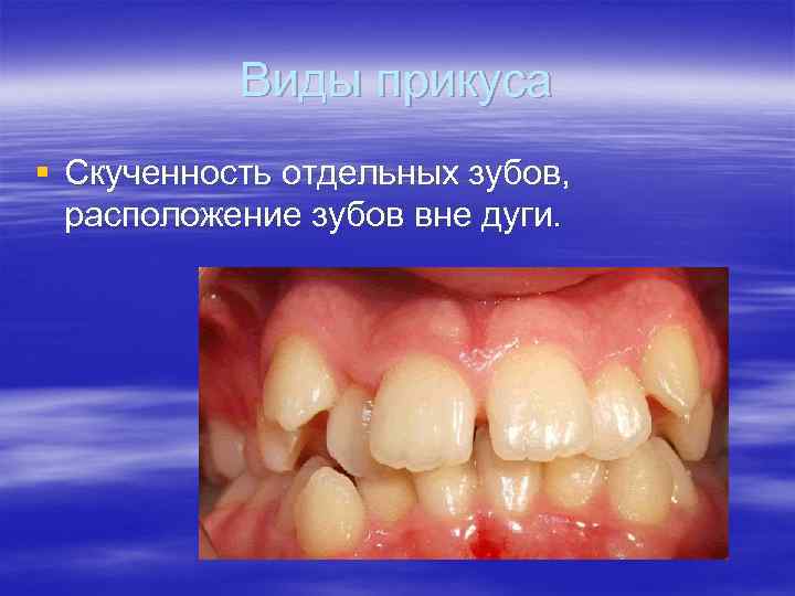 Виды прикуса § Скученность отдельных зубов, расположение зубов вне дуги. 