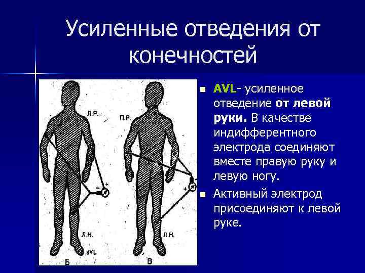 Усиленные отведения от конечностей n n АVL- усиленное отведение от левой руки. В качестве