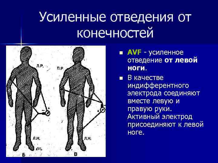 Усиленные отведения от конечностей n n АVF - усиленное отведение от левой ноги. В