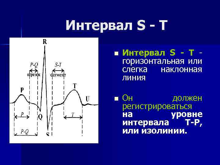 Интервал S - Т n Интервал S - Т горизонтальная или слегка наклонная линия