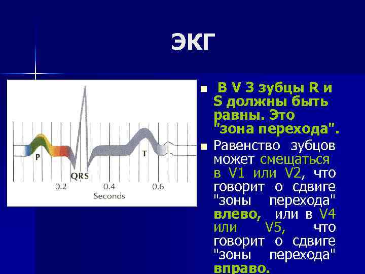 ЭКГ n n В V 3 зубцы R и S должны быть равны. Это