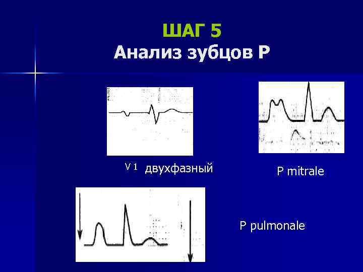 ШАГ 5 Анализ зубцов Р V 1 двухфазный P mitrale P pulmonale 