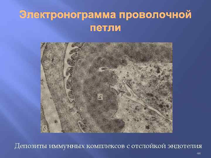 Электронограмма проволочной петли Депозиты иммунных комплексов с отслойкой эндотелия 44 