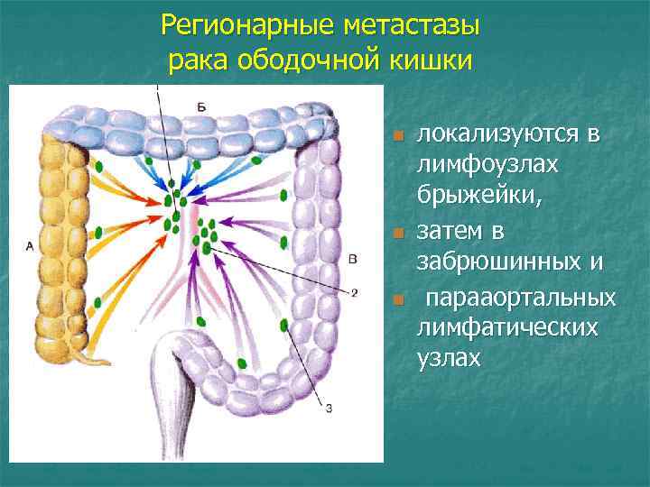 Регионарные метастазы рака ободочной кишки n n n локализуются в лимфоузлах брыжейки, затем в
