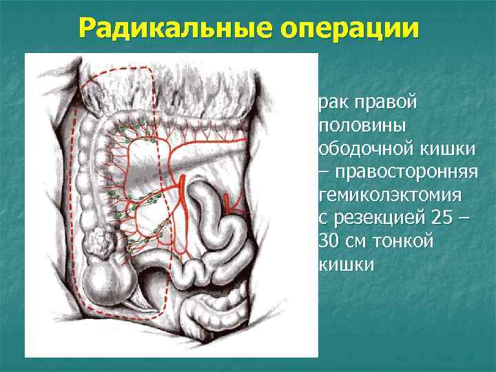 Радикальные операции рак правой половины ободочной кишки – правосторонняя гемиколэктомия с резекцией 25 –