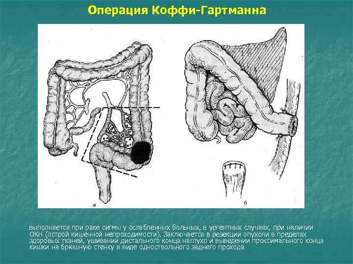Операция Коффи-Гартманна выполняется при раке сигмы у ослабленных больных, в ургентных случаях, при наличии