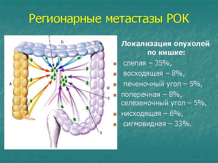 Регионарные метастазы РОК n n n Локализация опухолей по кишке: слепая – 35%, восходящая