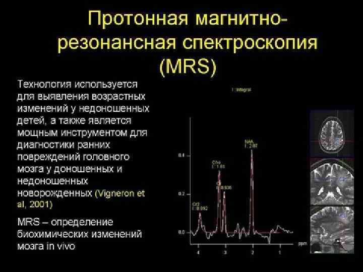 Изображение взвешенное по протонной плотности