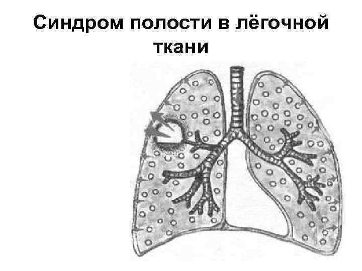 Синдром полости в лёгочной ткани 