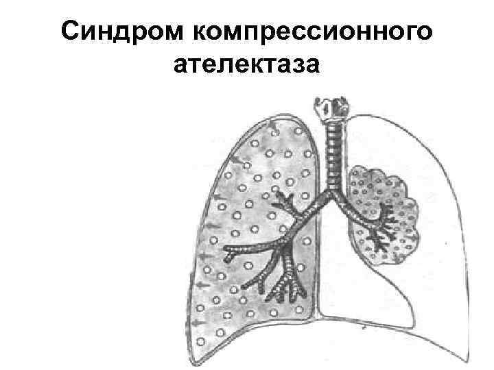 Синдром компрессионного ателектаза 