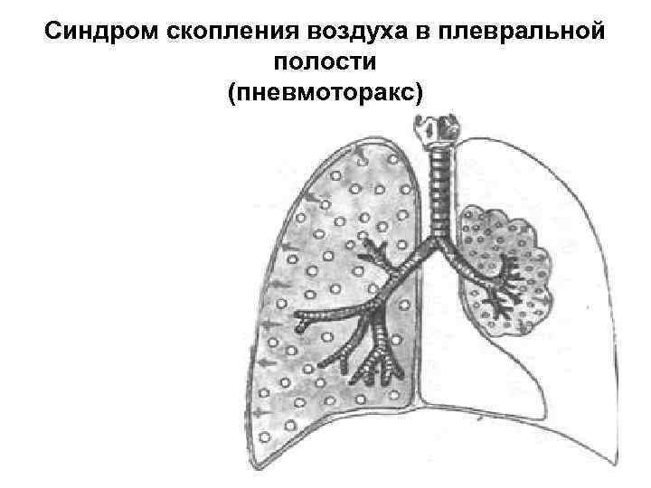 Синдром скопления воздуха в плевральной полости (пневмоторакс) 