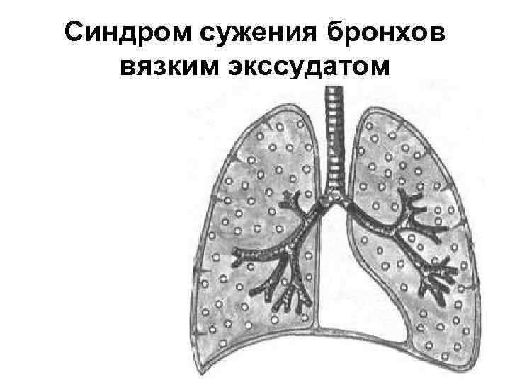 Синдром сужения бронхов вязким экссудатом 