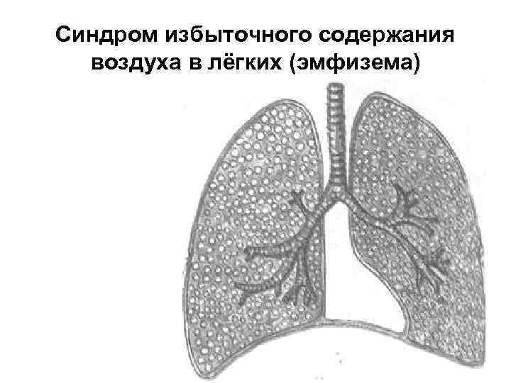 Синдром избыточного содержания воздуха в лёгких (эмфизема) 