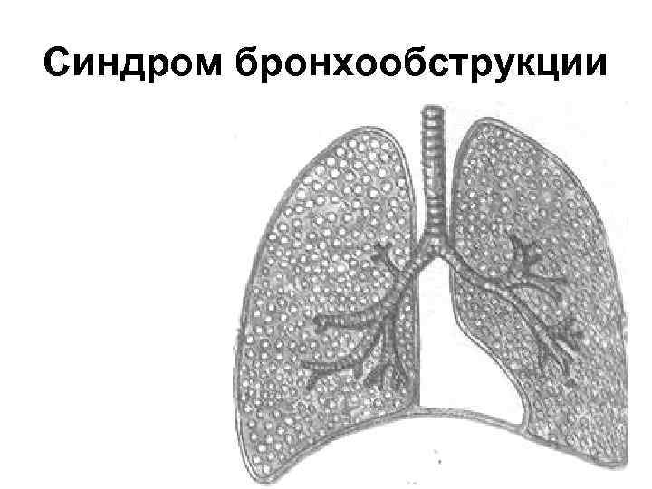Синдром бронхообструкции 