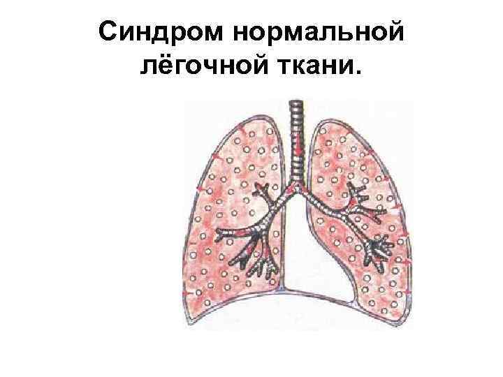 Синдром нормальной лёгочной ткани. 