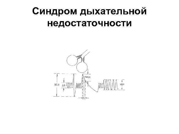 Синдром дыхательной недостаточности 