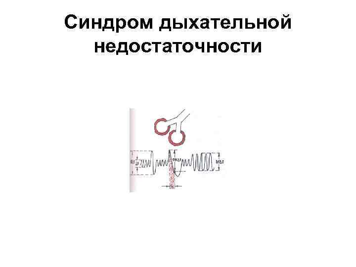 Синдром дыхательной недостаточности 