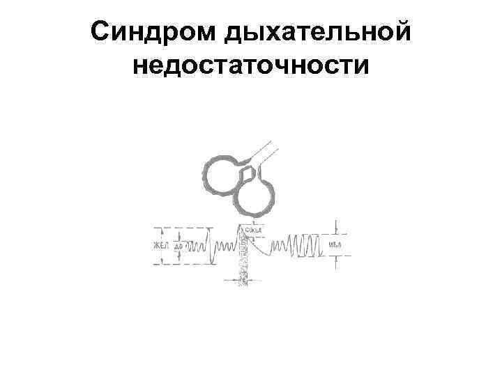 Синдром дыхательной недостаточности 