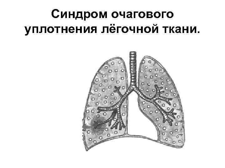 Синдром очагового уплотнения лёгочной ткани. 