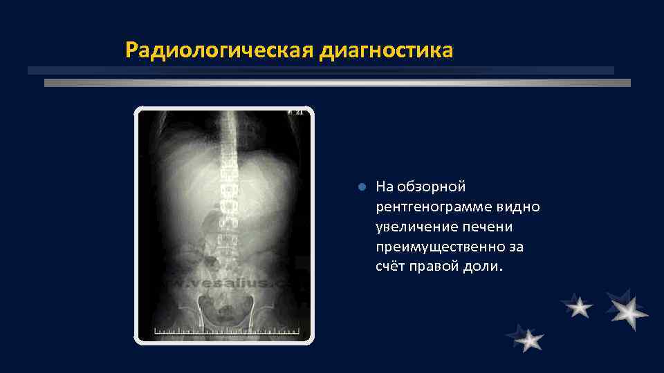 Радиологическая диагностика l На обзорной рентгенограмме видно увеличение печени преимущественно за счёт правой доли.