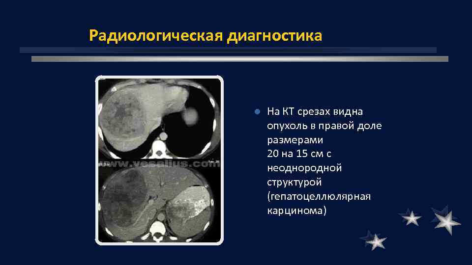 Радиологическая диагностика l На КТ срезах видна опухоль в правой доле размерами 20 на