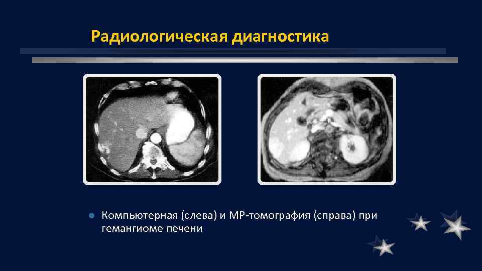 Радиологическая диагностика l Компьютерная (слева) и МР томография (справа) при гемангиоме печени 