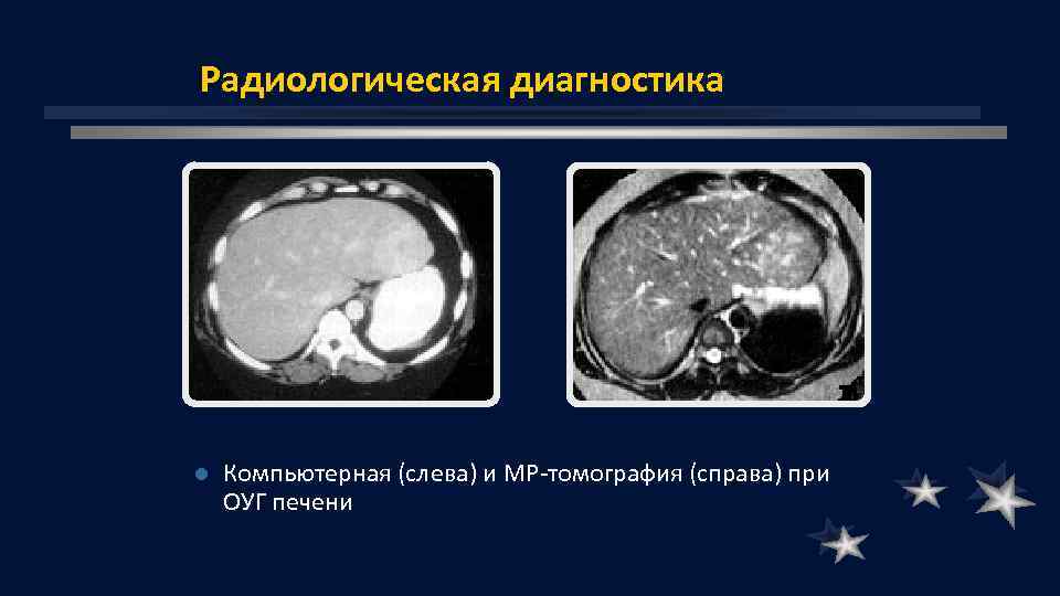 Радиологическая диагностика l Компьютерная (слева) и МР томография (справа) при ОУГ печени 