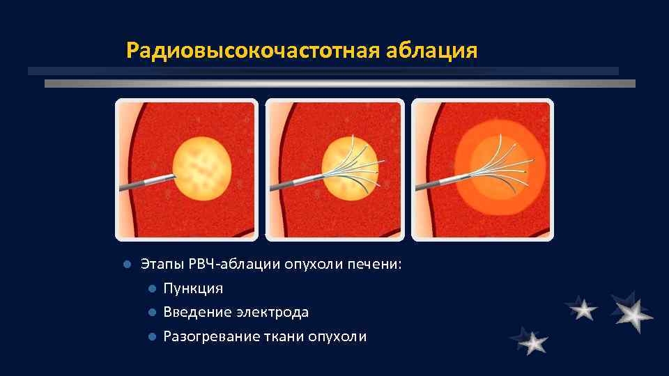 Радиовысокочастотная аблация l Этапы РВЧ аблации опухоли печени: l Пункция l Введение электрода l