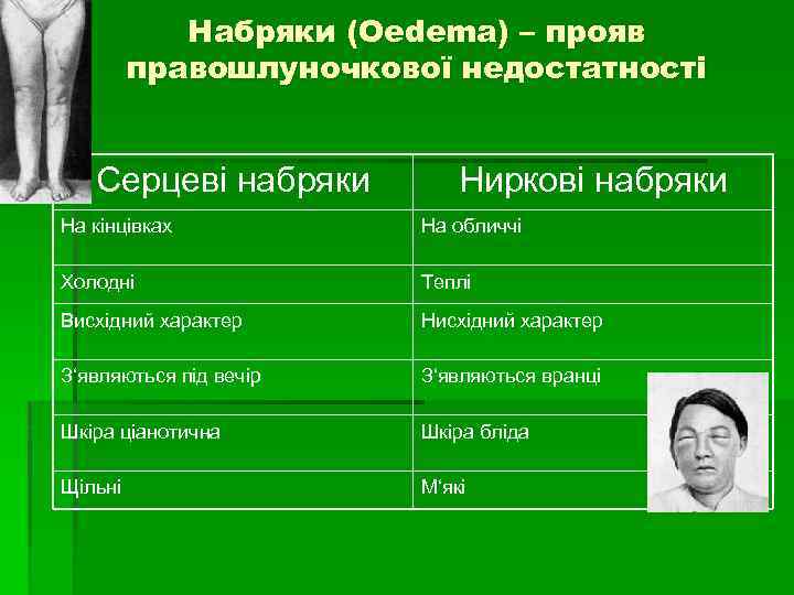 Набряки (Oedema) – прояв правошлуночкової недостатності Серцеві набряки Ниркові набряки На кінцівках На обличчі