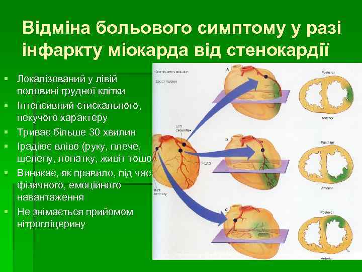 Відміна больового симптому у разі інфаркту міокарда від стенокардії § Локалізований у лівій половині