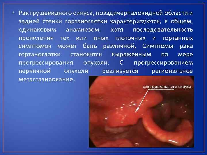  • Рак грушевидного синуса, позадичерпаловидной области и задней стенки гортаноглотки характеризуются, в общем,