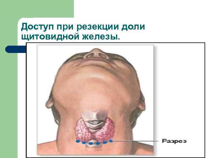 Доступ при резекции доли щитовидной железы. 
