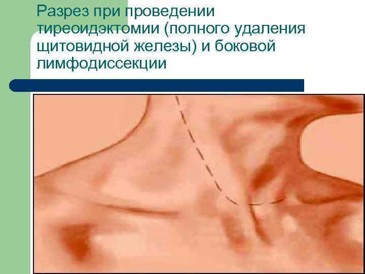 Разрез при проведении тиреоидэктомии (полного удаления щитовидной железы) и боковой лимфодиссекции 