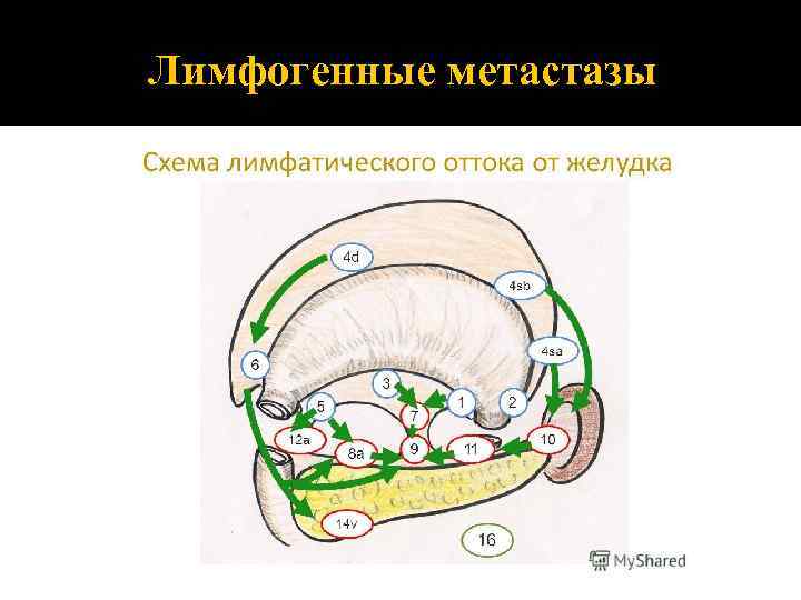 Лимфогенные метастазы 