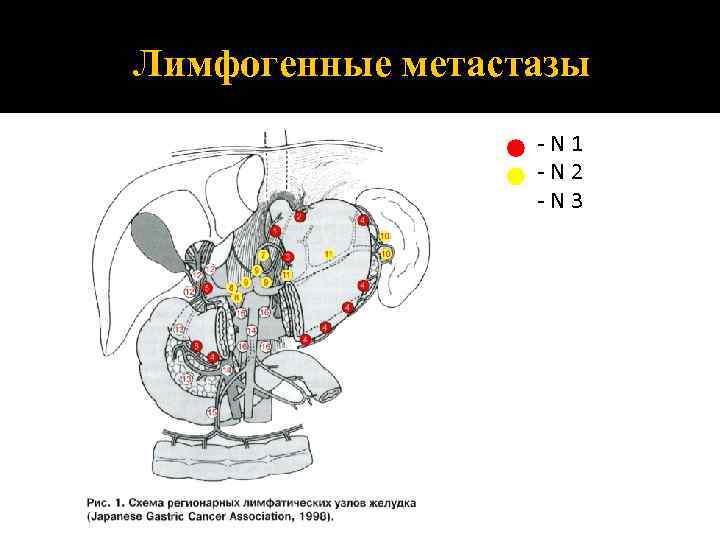 Лимфогенные метастазы -N 1 -N 2 -N 3 