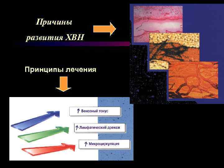 Причины развития ХВН Принципы лечения 