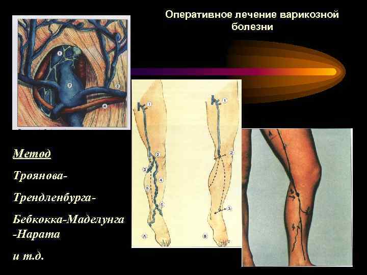 Оперативное лечение варикозной болезни Метод Троянова. Трендленбурга. Бебкокка-Маделунга -Нарата и т. д. 
