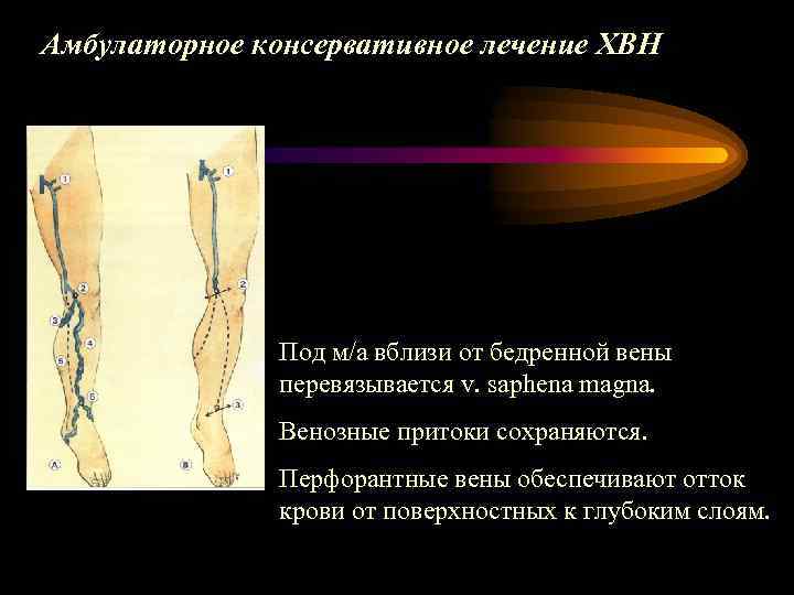 Амбулаторное консервативное лечение ХВН Под м/а вблизи от бедренной вены перевязывается v. saphena magna.