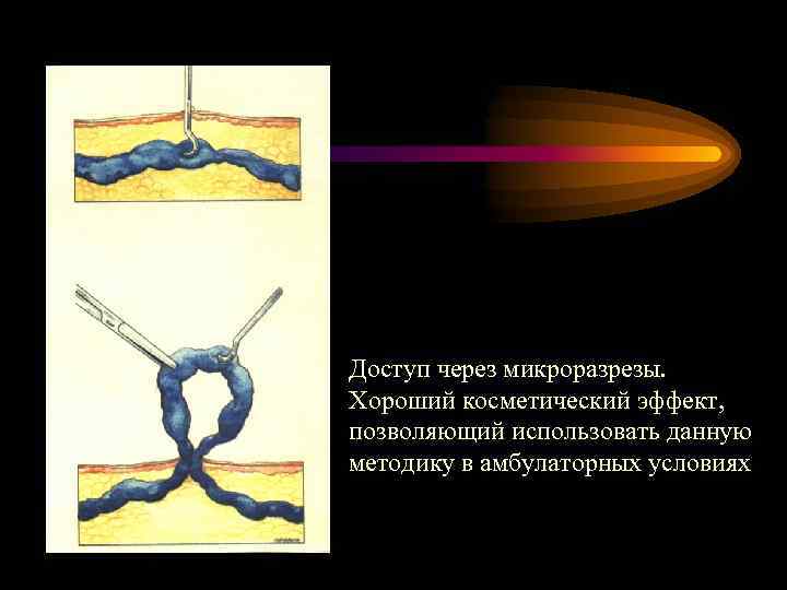 Доступ через микроразрезы. Хороший косметический эффект, позволяющий использовать данную методику в амбулаторных условиях 