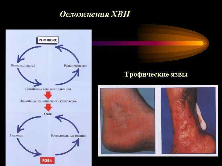 Осложнения ХВН Трофические язвы 